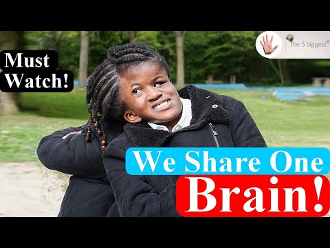 Conjoined Twins Neev and Nelly: I Wish I Had Seen This Before ~ Body Bizarre!