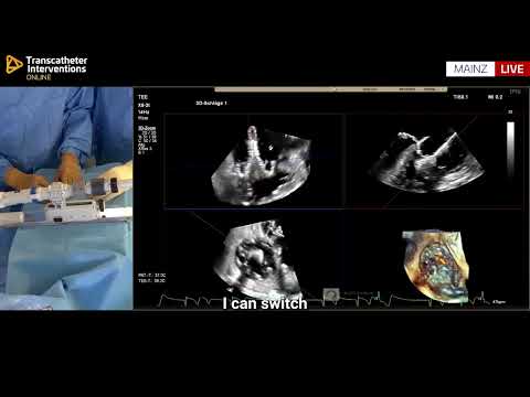 Final EVOQUE Optimisation in TTVR – Tilt Adjustment with MPR Echo and Fluoro