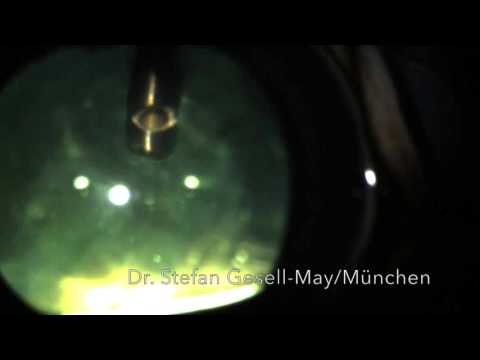 Vitrektomie Pferd bei ERU bzw. "periodischer Augenentzündung"