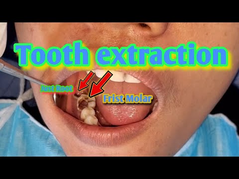 Tooth Extraction - Lower First Molar And Root