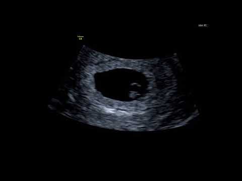 What Can You See At A 6 Week Baby Scan?