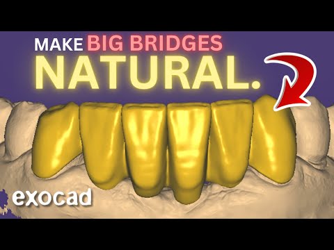 ANTERIOR Bridge EXOCAD. 2024 Tutorial