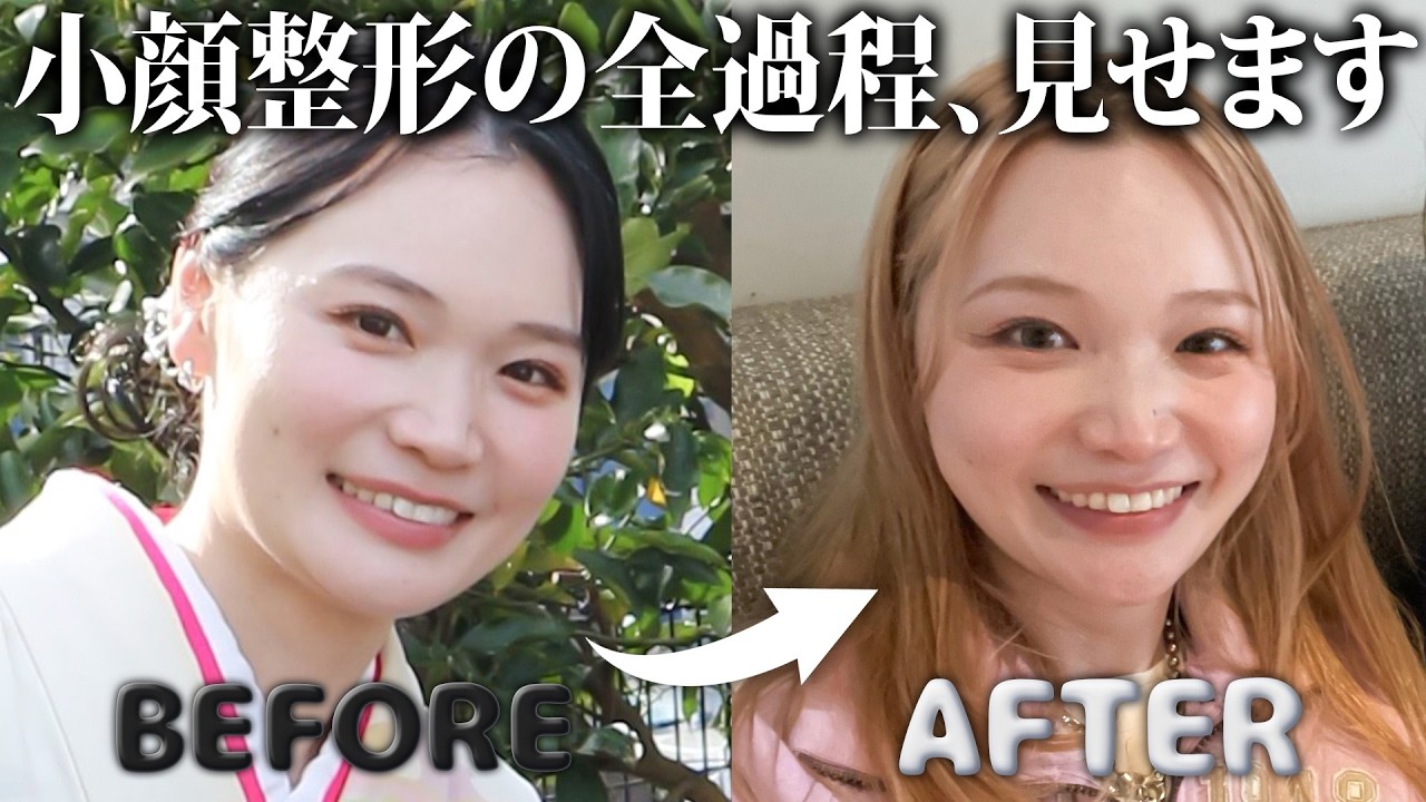 【A CLINIC×もえちょびん】気になる美容施術をリアルレビュー