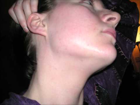 comment appliquer roaccutane gel