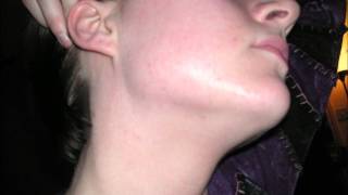 My acne recovery video - Cleared with Finacea 15% Gel (twice a day)