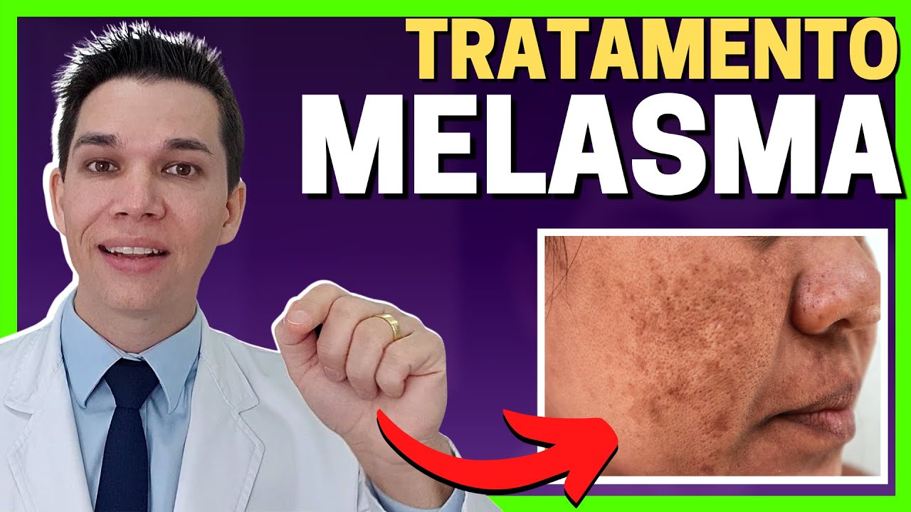 Como TRATAR MELASMA no Rosto: Guia Definitivo