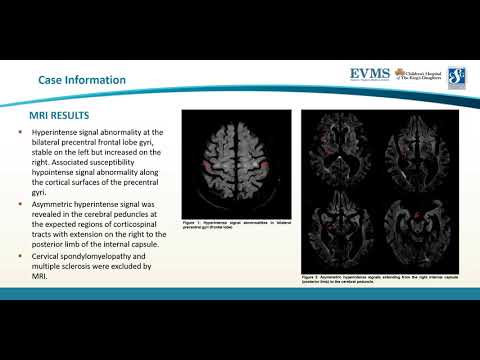 Thumbnail image of video presentation for An Interesting Case of Rapidly Progressive Primary Lateral Sclerosis