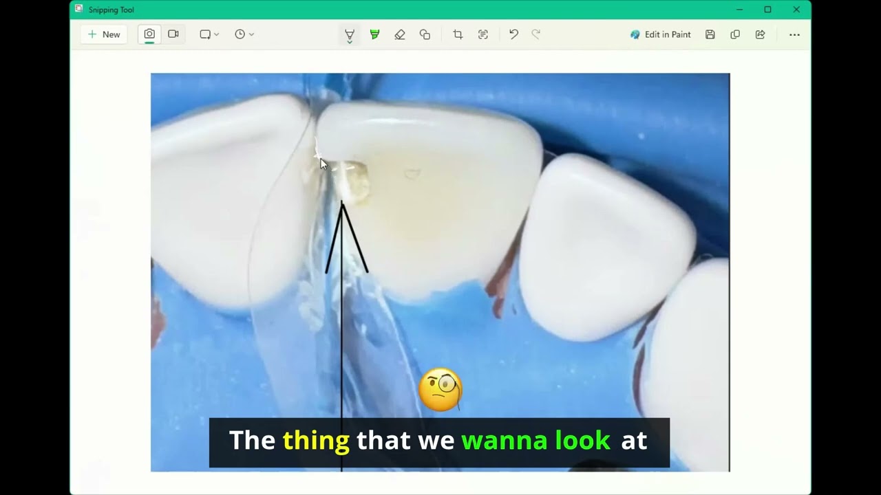 The dentist's secret for perfect dental contacts revealed!