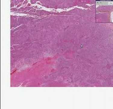 Histopathology Adrenal--Adrenocortical carcinoma