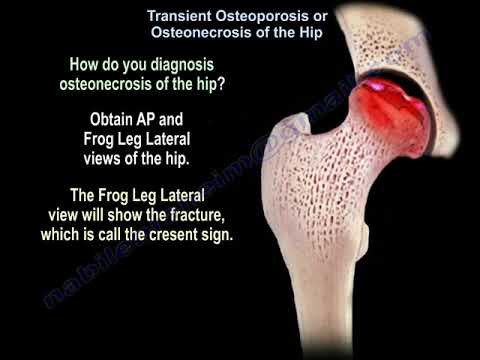 Osteonecrosis Of The Hip   - Everything You Need To Know - Dr. Nabil Ebraheim