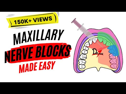Maxillary Nerve Block: Anesthesia For Dental Procedures