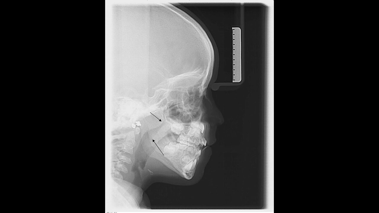 Deformaciones de la cara por respiración bucal T.22