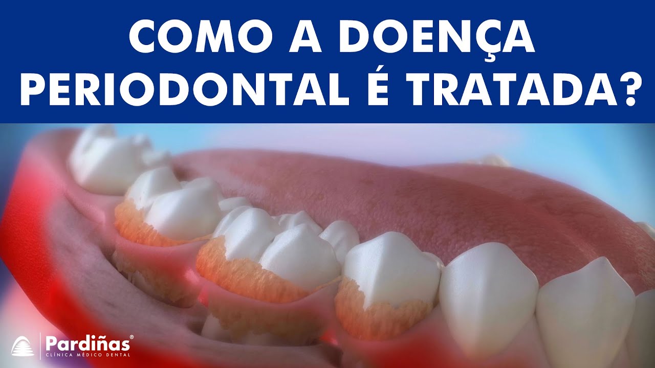 Doença periodontal e sua influência sobre a saúde ©
