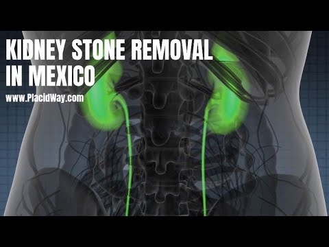 Kidney Stone Removal in Mexico