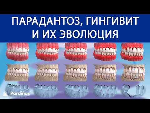 Парадантоз, гингивит и их эволюция ©