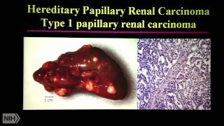 The Genetic Basis of Kidney Cancer: Targeting the Metabolic Basis of Disease
