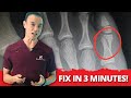 How To Fix A Broken Toe At Home In 3 Minutes Quick Easy Recovery Tips
