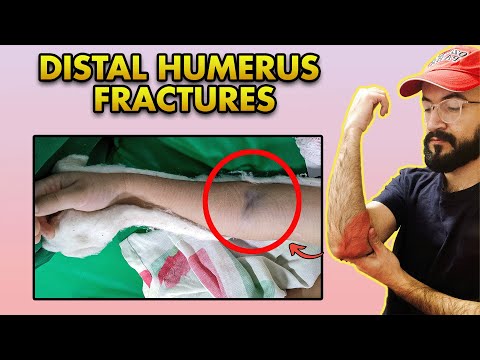 Distal Humerus Fractures: AO Classification, Clinical Features, Treatment and Complications