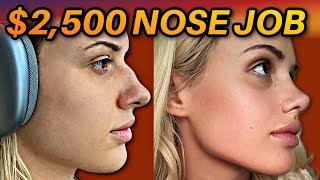 the internet said my nose job was UGLY & BOTCHED- RESULTS