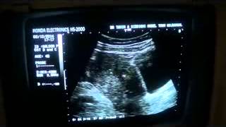 DIFFUSE  MYOMETRITIS post D and C