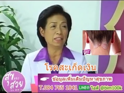 เล็บกลากรักษา ยา dexamethasone ในโรคสะเก็ดเงิน