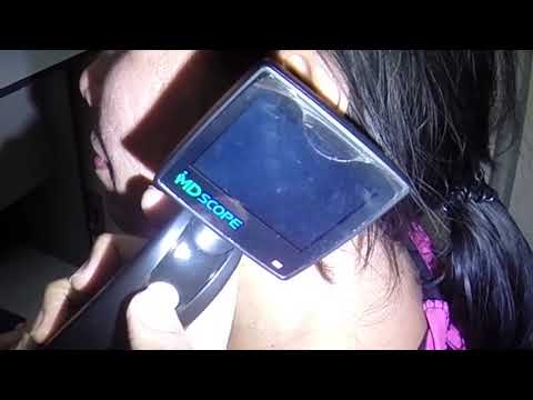 Woman's Dry Flaky Earwax Removal with Alligator Forceps