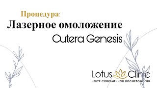 Лазерное омоложение Cutera Genesis