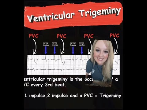 Ventricular Trigeminy || EMS Cardiology