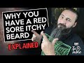 Why your skin is red, itchy and sore under your beard