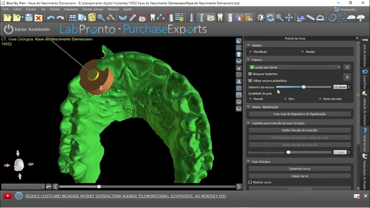 como fazer guia cirúrgica simples no BSB
