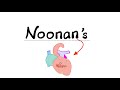 Noonan Syndrome The Mushroom Mnemonic