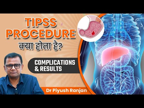 TIPSS Procedure क्या होता है? | TIPS Complications and Results? | Dr. Piyush Ranjan