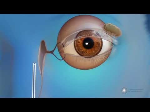 What is endoscopic dacryocystorhinostomy (DCR) surgery for blocked tear ducts?