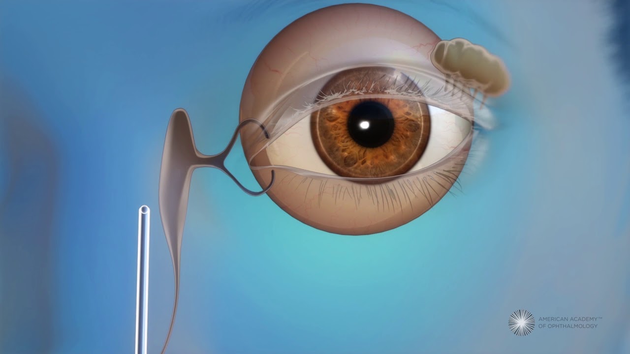 What is endoscopic dacryocystorhinostomy (DCR) surgery for blocked tear ducts?