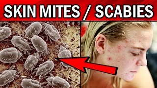 8 Effective Remedies To Get Rid of Skin Mites/Scabies Naturally