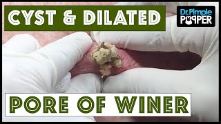 Huge Blackhead, Big Open Cyst, or a Nice Dilated Pore of Winer?  What's your guess?