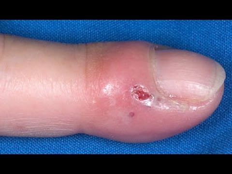 How to Treat Whitlow: Medical Treatments & Home Remedies