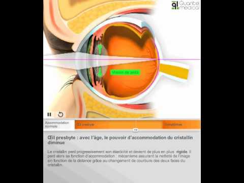 pourquoi la vue baisse avec l'age