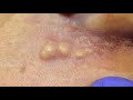 Whiteheads, Blackheads Extractions on the Ear