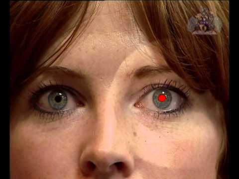 ophthalmoscopy video