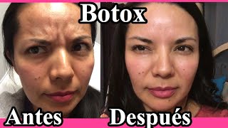 BOTOX - Antes y Después
