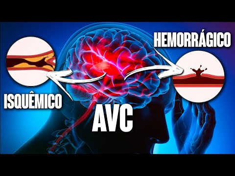 Stroke: What you need to know!