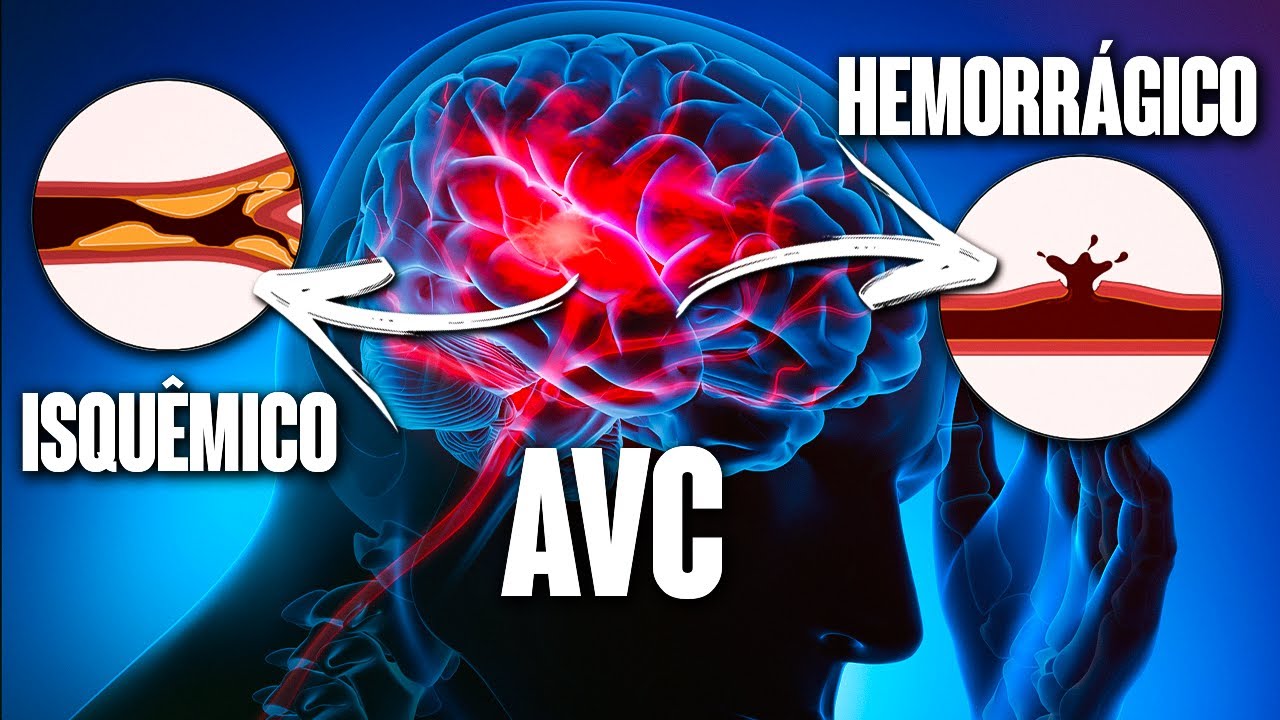 AVC: O QUE VOCÊ PRECISA SABER!