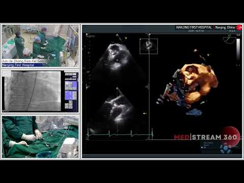 TAVI Using a 23mm Sapien 3 Valve