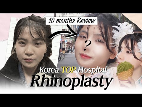 10-Month Review of TOP Korean Rhinoplasty | You Must Watch This Before Getting a Nose Job