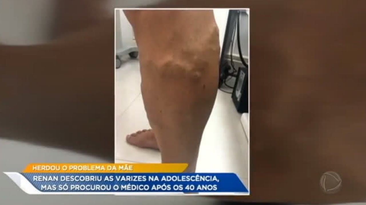 Homem faz cirurgia de varizes para se livrar de fortes dores nas pernas