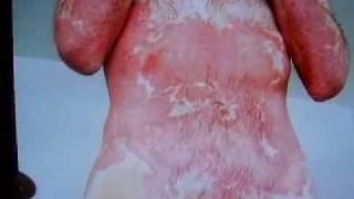 preview picture of video 'Psoriasis Eczema Video Stop Eating Dairy'