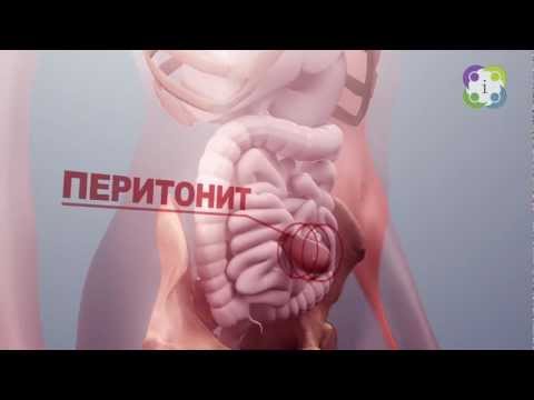 киста на матке фото и что делать