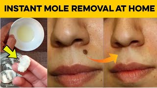 How to Get Rid of Moles on Face Quickly | Natural Home Remedies for Mole Removal at Home