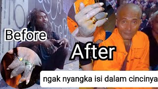 Download lagu Removing 6 rings from the fingers of a mentally ill person, who didn't expect what was inside the... mp3